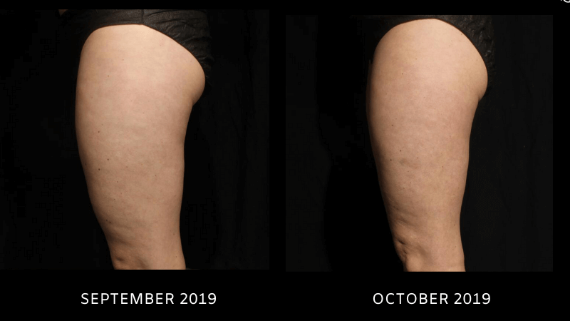 EMtone Before and After